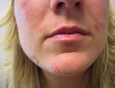 «Καλόγερος»: Πώς θα τον αντιμετωπίσετε με τον καλύτερο τρόπο